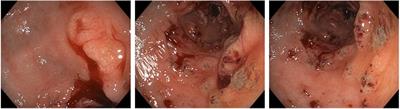 Case report: Rapid onset, ischemic-type gastritis after initiating oral iron supplementation